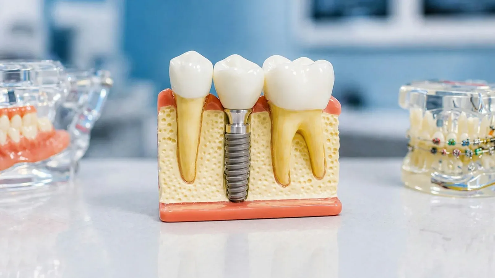 Dental Crowns in Miami & Fort Lauderdale