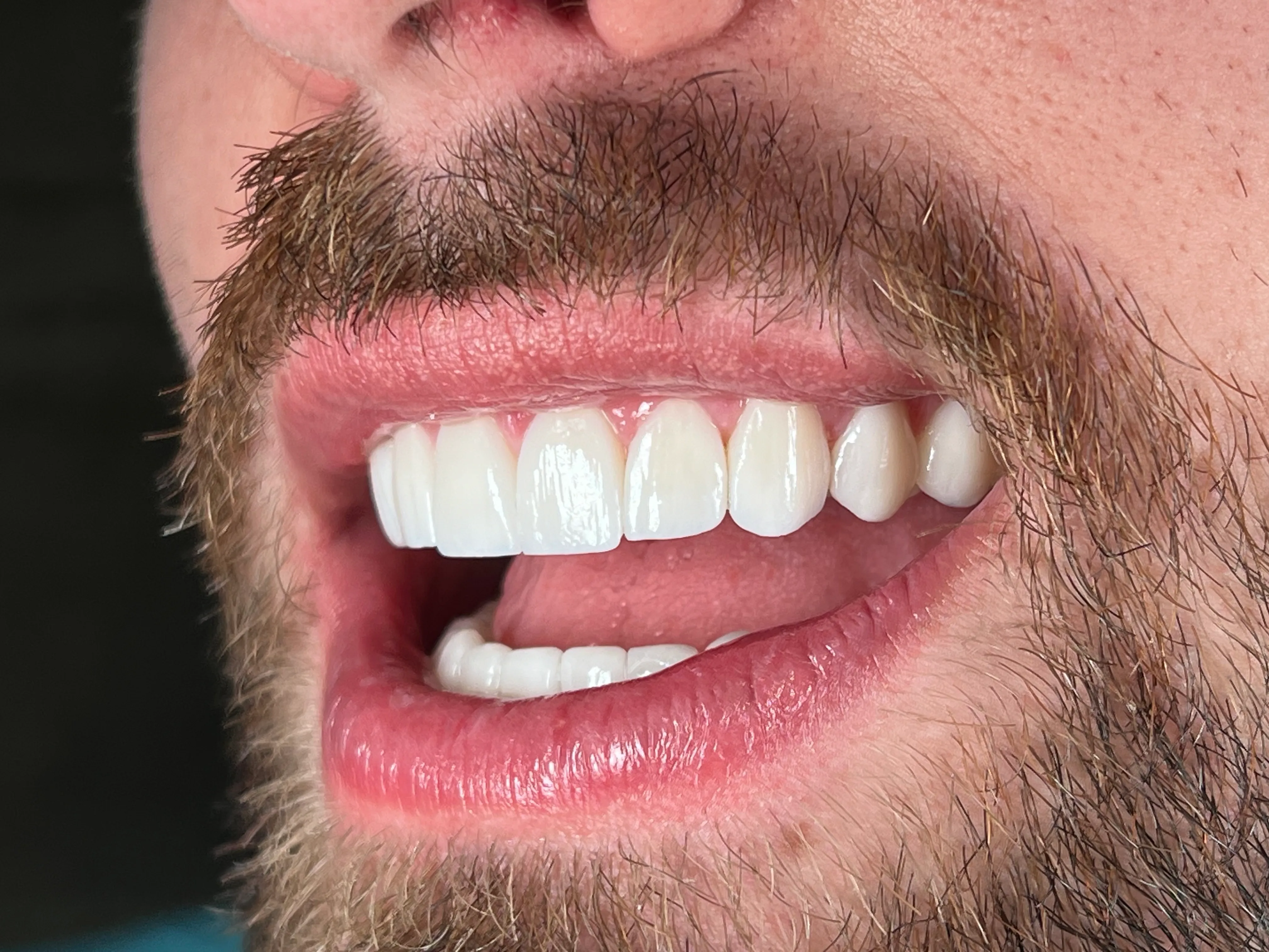 Dental Implants photo