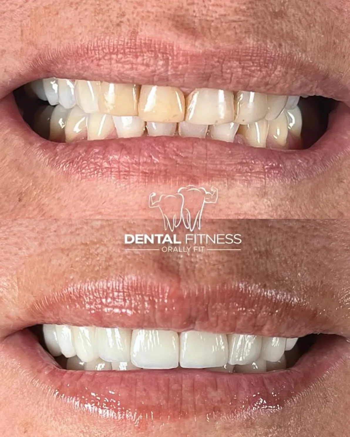 Before and after smile transformation (1)