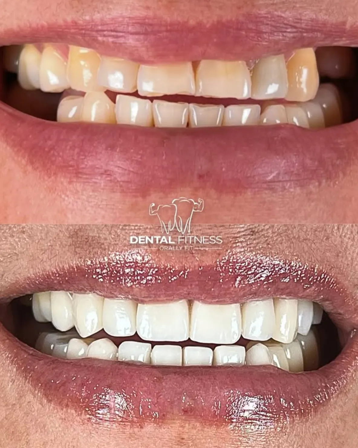 Before and after smile transformation (2)