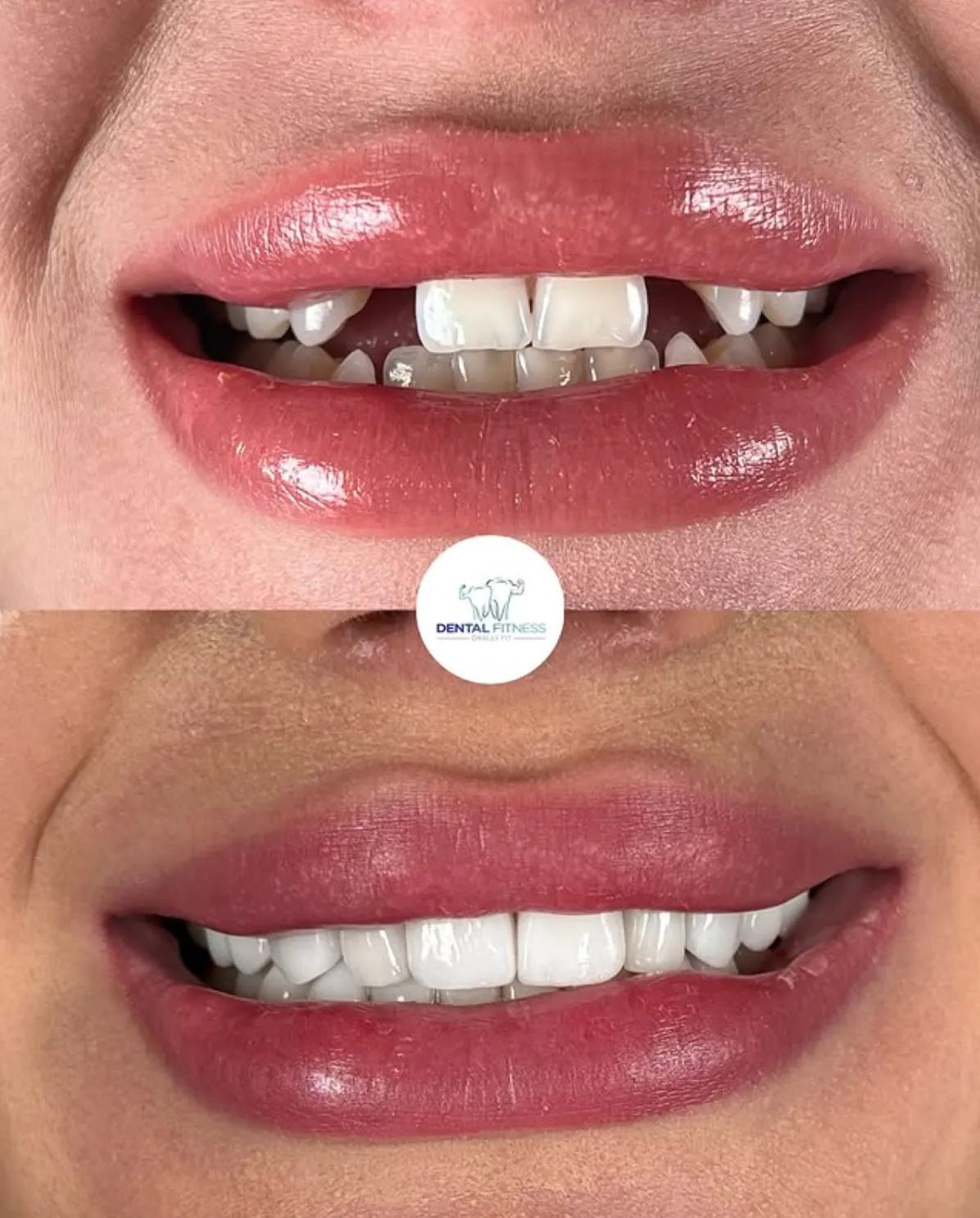 Before and after smile transformation (3)