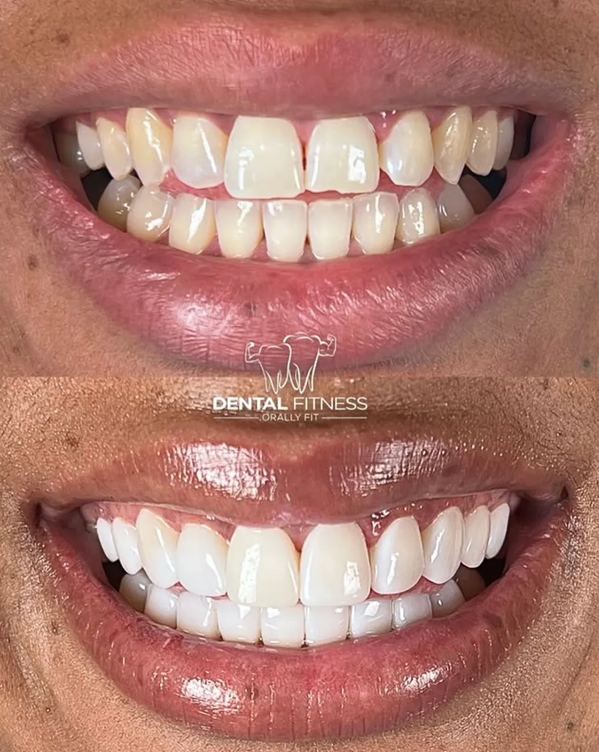 Before and after smile transformation (4)