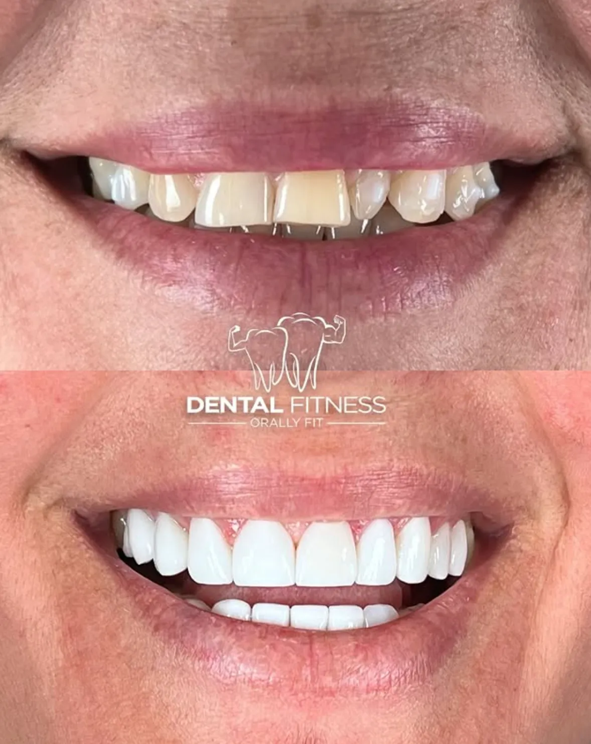 Before and after smile transformation (5)
