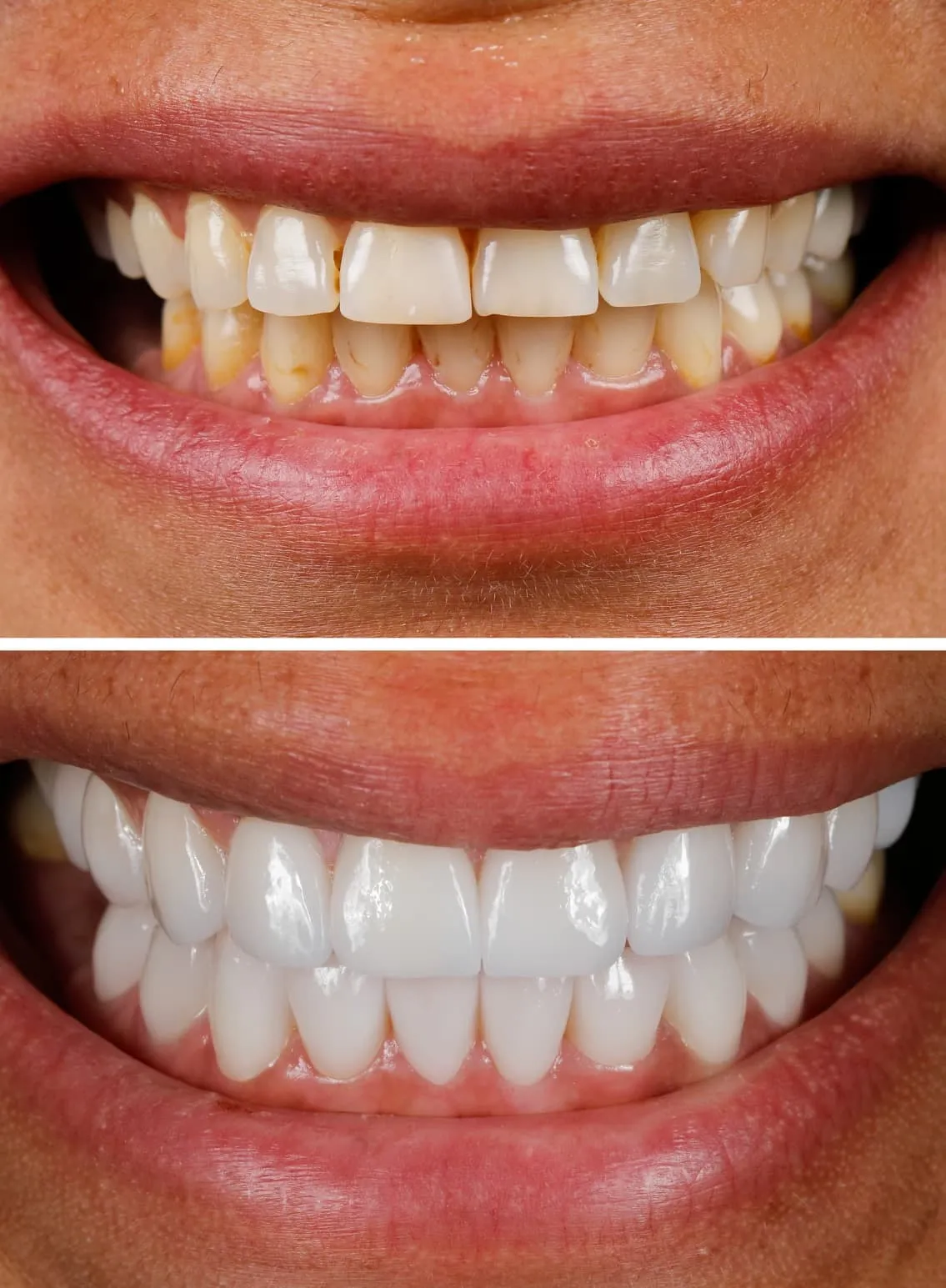 Extreme close-up before and after professional whitening and veneers removing heavy staining for a bright, even smile